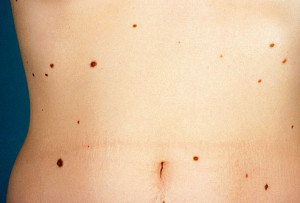 phototake_photo_of_atypical_nevi_on_torso