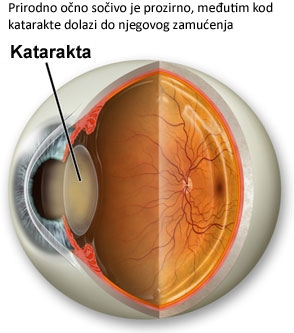 Katarakta