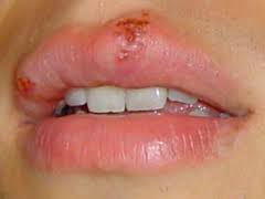 Narodni recepti za lečenje herpes simpleks