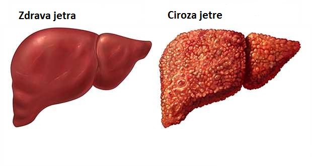 ciroza1