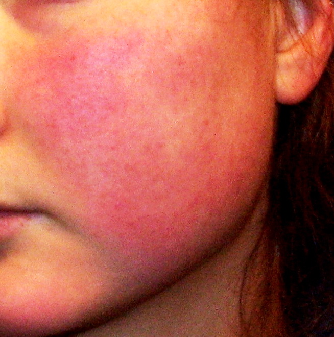 Rosacea – hronično obolenje kože lica