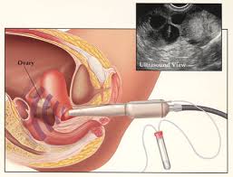 IVF u prirodnom ciklusu