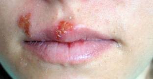 Šta uzrokuje herpes na usni