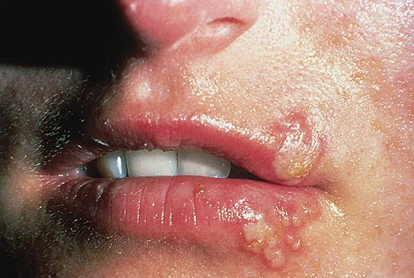 Prirodno rešenje za herpes