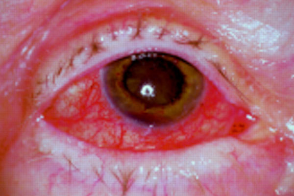 Scleritis-3