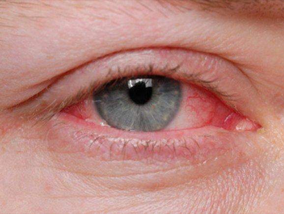Alergijski konjunktivitis- Simptomi i lečenje