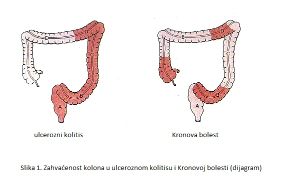 Kronova bolest