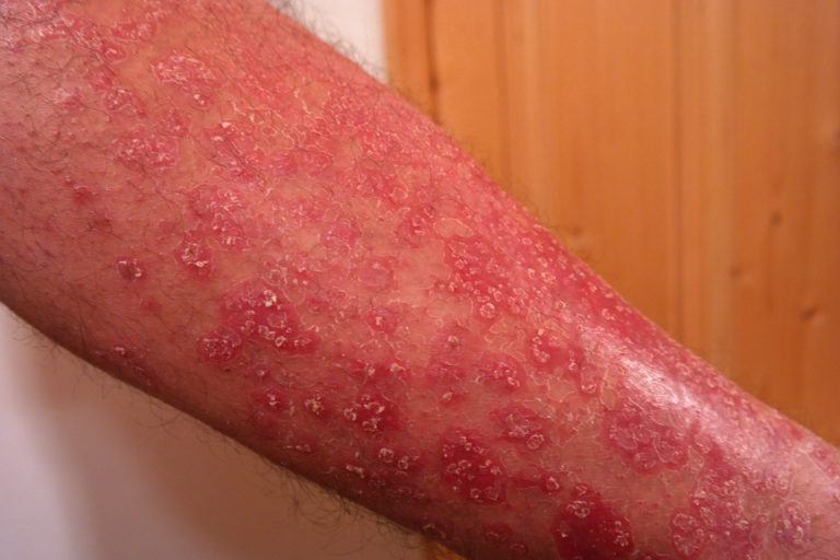 Ovo su uzroci pojave psorijaze
